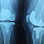 Endoprotezy w ortopedii