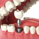 Implanty zębowe Szczecin